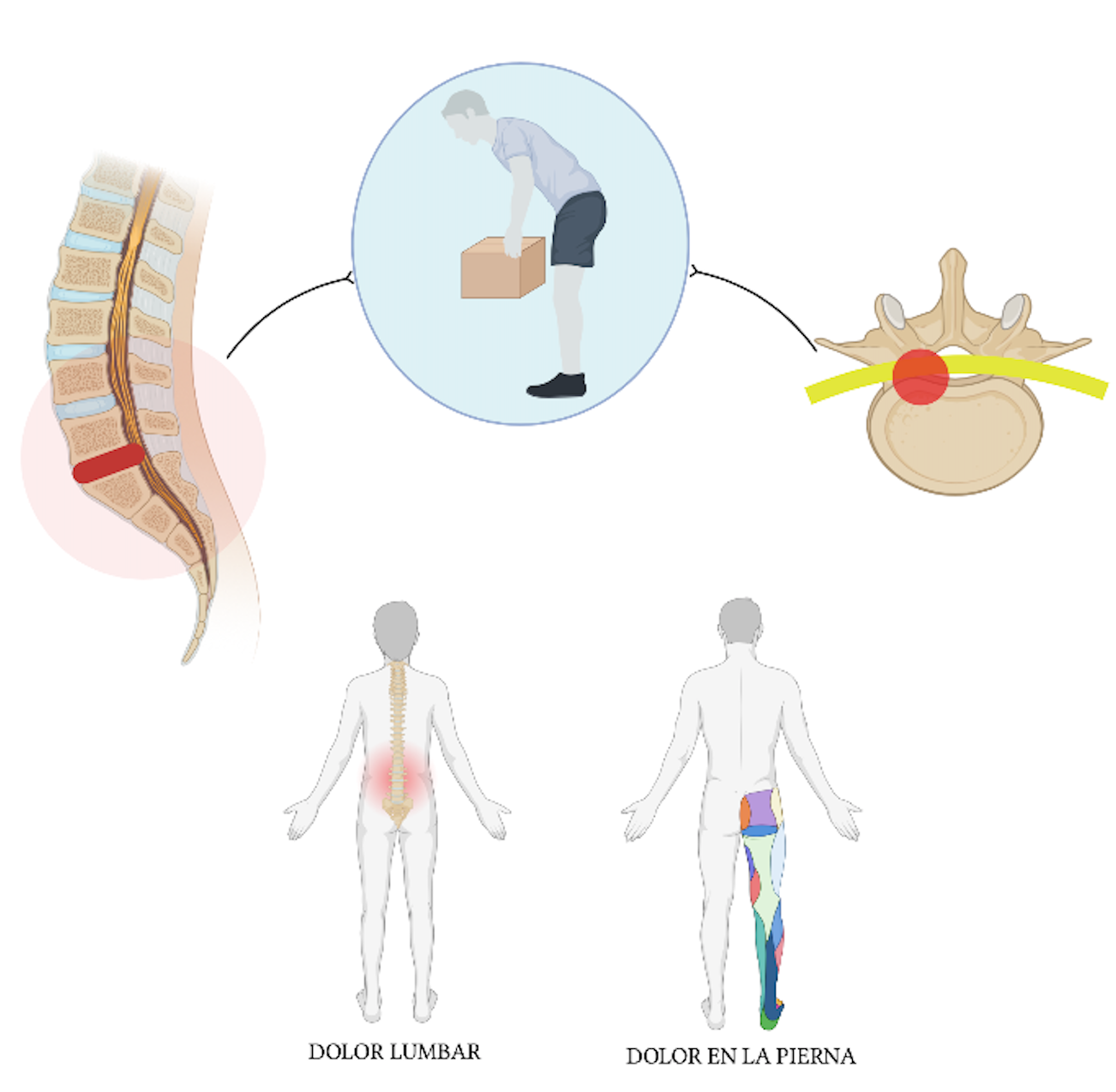 Hombre cargando peso, hernia discal lumbar, dolor ciático, dolor lumbar