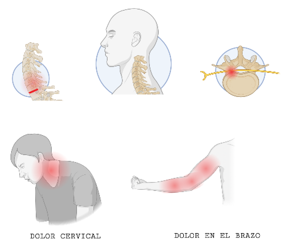 HERNIA DISCAL CERVICAL. CERVICALGIA. DOLOR EN EL BRAZO.