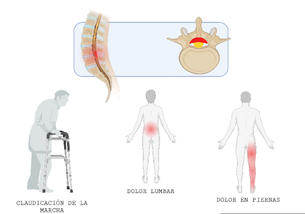 Dolor lumbar. Claudicación de la marcha. Dolor en la pierna. Estenosis canal lumbar. Estenosis lumbar.