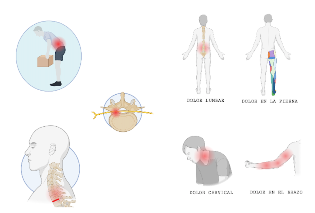 Hernia discal. Dolor lumbar. Dolor cervical. Lumbalgia. Cervicalgia. Dolor irradiado a brazo. Dolor irradiado a pierna.
