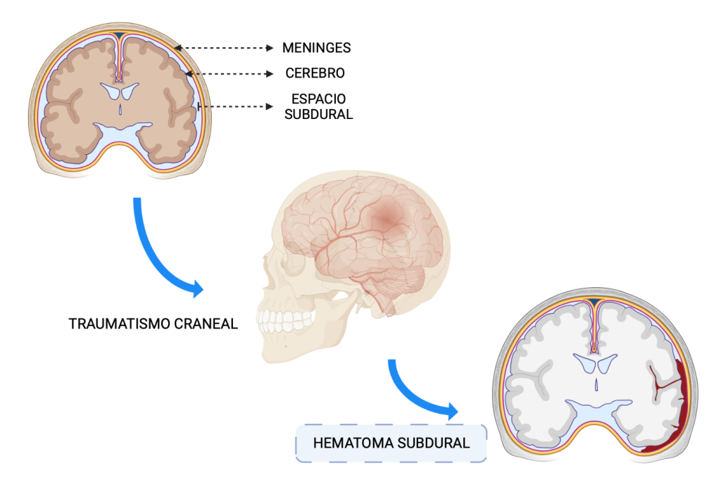 TRAUMATISMO CRANEAL. TRAUMA. HEMATOMA SUBDURAL CRÓNICO. HEMATOMA. SANGRE. SANGRADO.