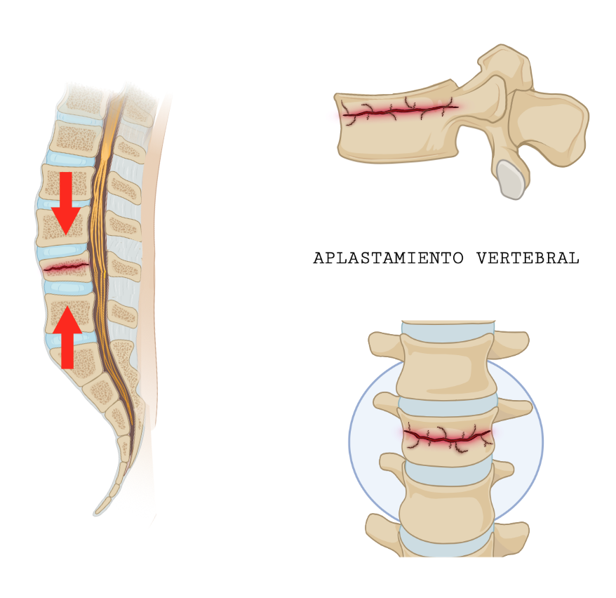 Dolor lumbar. Aplastamiento vertebral. Fractura vertebral osteoporótica