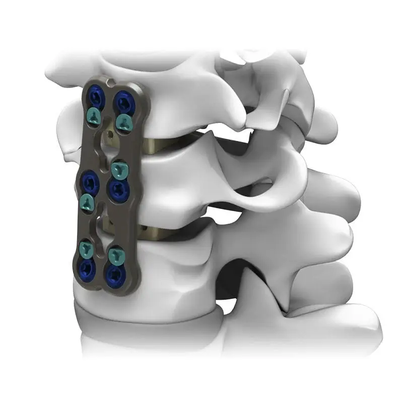 mielopatía cervical